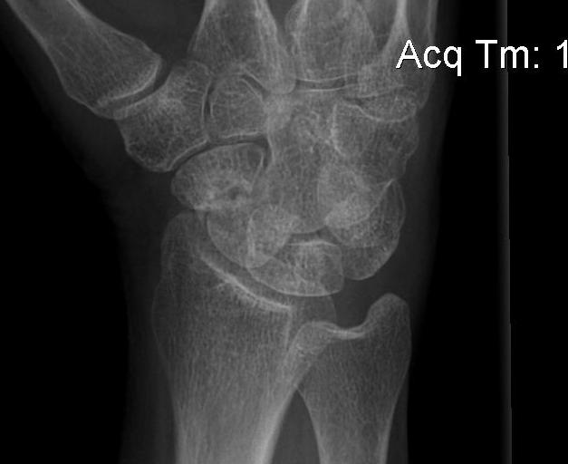 Scaphoid Non union xray